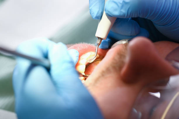 Best Urgent Care for Lost Fillings or Crowns in New Wilmington, PA